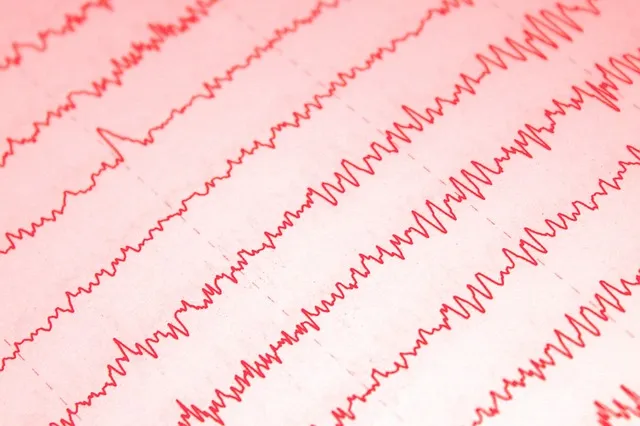 EEG (Elektroensefalografi) Nedir? EEG (Elektroensefalografi) Nedir?